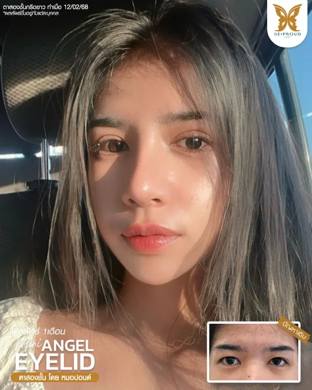 ภาพรีวิวคนสวย ตาสองชั้นกรีดตายาวแผลมินิ โดยหมอปอนด์ (นพ.พิชญ์) บีพราวด์คลินิก แสดงผลลัพธ์ ชั้นตาสวยคมชัด ดวงตาดูสดใส