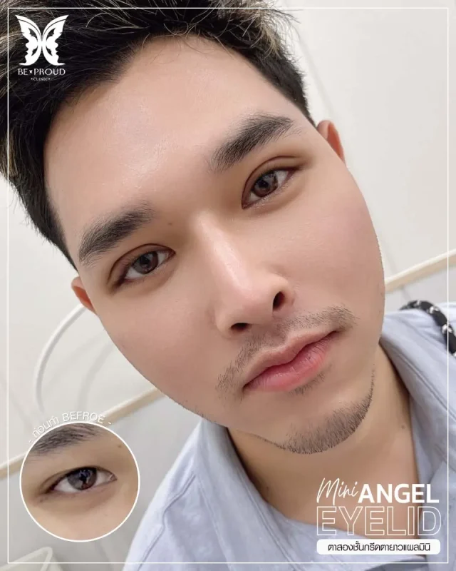ภาพรีวิวคนสวย ตาสองชั้นผู้ชายเทคนิค กรีดยาวแผลมินิ โดย อ.หมอหลิง (พญ.กัญญ์ชิสา) บีพราวด์คลินิก แสดงผลลัพธ์ ชั้นตาสวยคมชัด ดวงตาดูสดใส