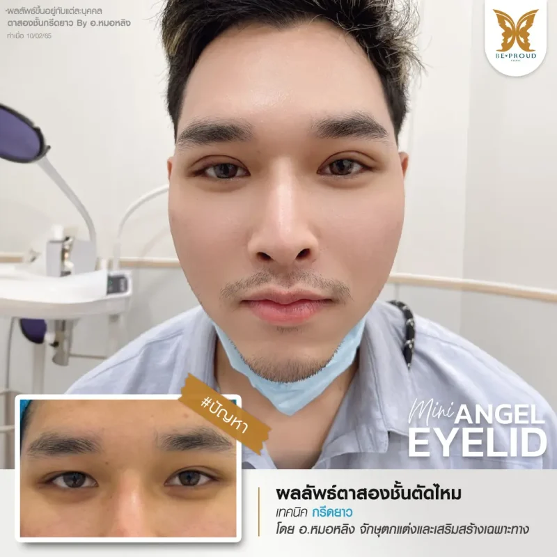 ภาพรีวิวเปรียบเทียบผลลัพธ์ ก่อนทำ-หลังทำศัลยกรรมตาสองชั้นผู้ชาย ของเคสตัวอย่าง เทคนิคกรีดตายาว โดยอ.หมอหลิง บีพราวด์คลินิก