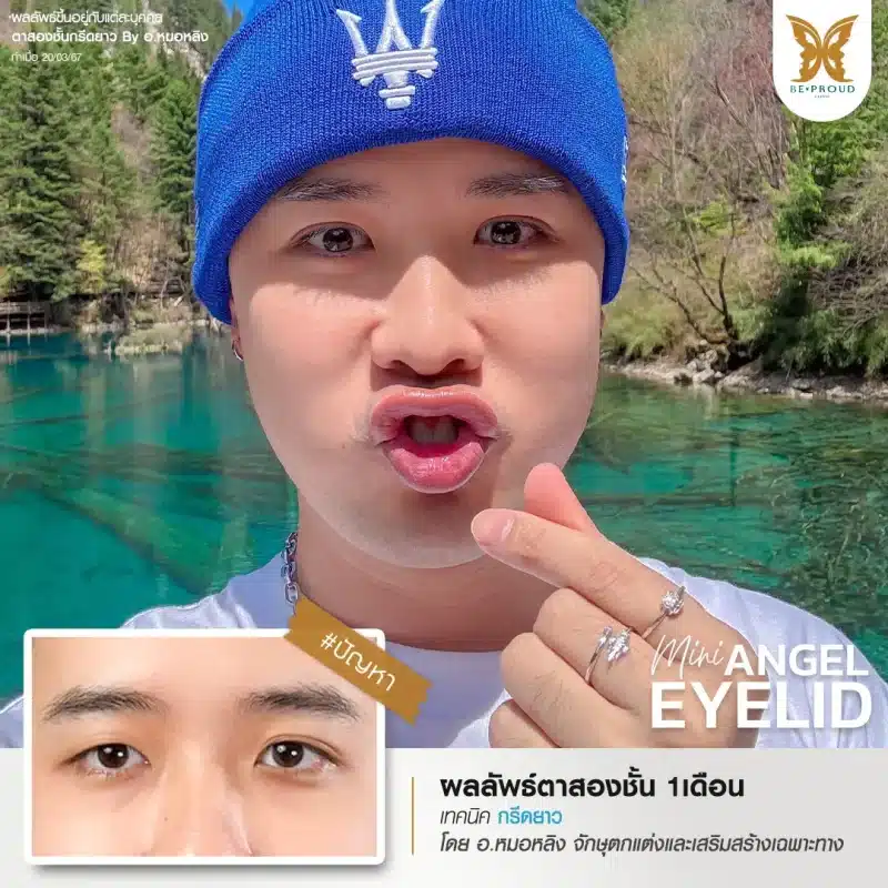 ภาพรีวิวเปรียบเทียบผลลัพธ์ ก่อนทำ-หลังทำศัลยกรรมตาสองชั้นผู้ชาย ของเคสตัวอย่าง เทคนิคกรีดตายาว โดยหมอดา บีพราวด์คลินิก