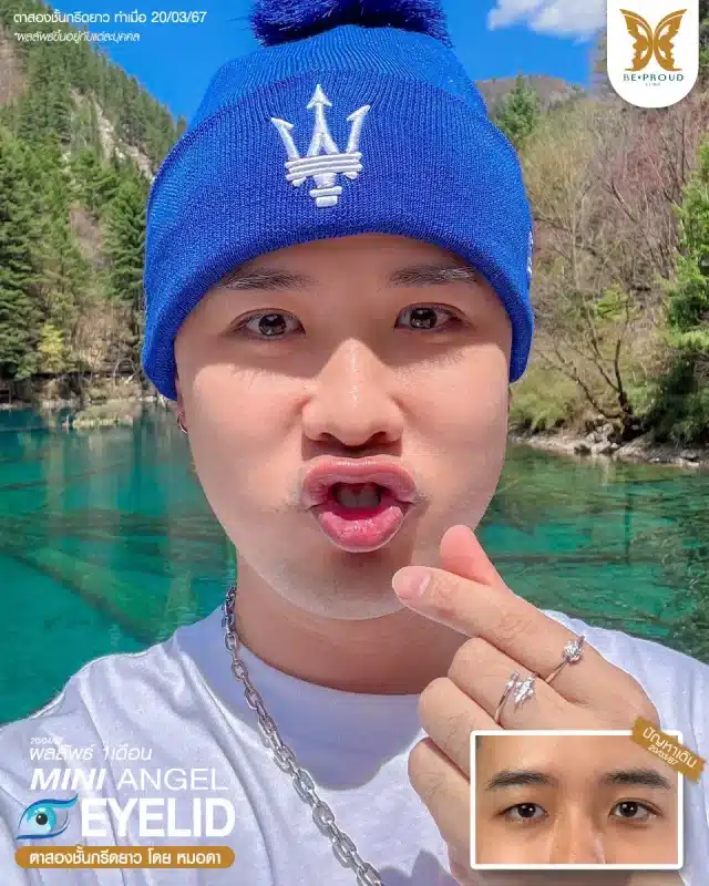 ภาพรีวิวคนสวย ตาสองชั้นผู้ชายกรีดตายาว โดยหมอดา (พญ.สร้อยสุดา) บีพราวด์คลินิก แสดงผลลัพธ์ ชั้นตาสวยคมชัด ดวงตาดูสดใส