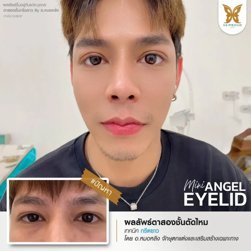 ภาพรีวิวเปรียบเทียบผลลัพธ์ ก่อนทำ-หลังทำศัลยกรรมตาสองชั้นผู้ชาย ของเคสตัวอย่าง เทคนิคกรีดตายาว แก้กล้ามเนื้อตาอ่อนแรง โดยอ.หมอหลิง บีพราวด์คลินิก