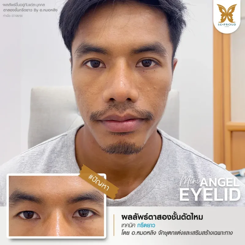ภาพรีวิวเปรียบเทียบผลลัพธ์ ก่อนทำ-หลังทำศัลยกรรมตาสองชั้นผู้ชาย ของเคสตัวอย่าง เทคนิคกรีดตายาว โดยอ.หมอหลิง บีพราวด์คลินิก