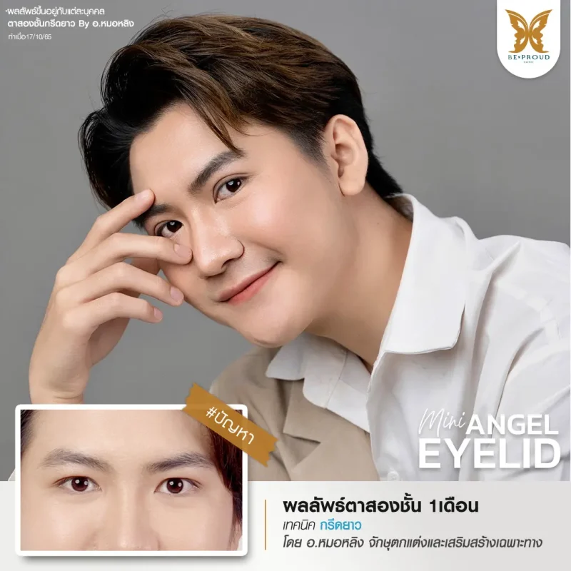 ภาพรีวิวเปรียบเทียบผลลัพธ์ ก่อนทำ-หลังทำศัลยกรรมตาสองชั้นผู้ชาย ของเคสตัวอย่าง เทคนิคกรีดยาวแผลมินิ โดยอ.หมอหลิง บีพราวด์คลินิก