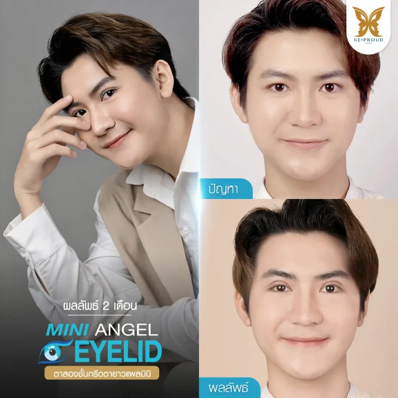 ภาพรีวิวเปรียบเทียบผลลัพธ์ ก่อนทำ-หลังทำศัลยกรรมตาสองชั้นผู้ชาย ของเคสตัวอย่าง เทคนิคกรีดยาวแผลมินิ โดยอ.หมอหลิง บีพราวด์คลินิก