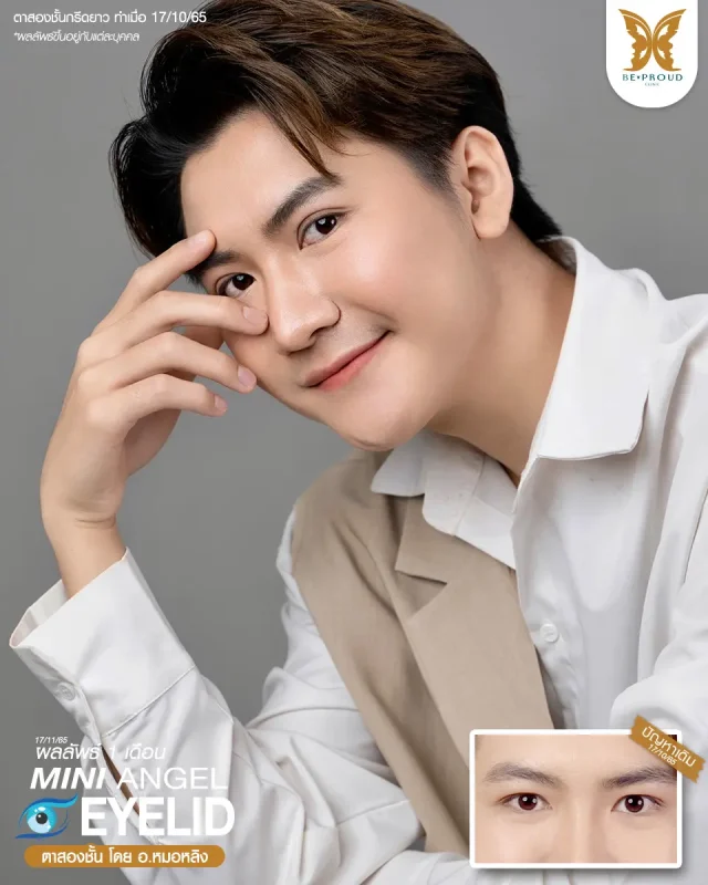 ภาพรีวิวคนสวย ตาสองชั้นผู้ชายเทคนิค กรีดตายาว โดย อ.หมอหลิง (พญ.กัญญ์ชิสา) บีพราวด์คลินิก แสดงผลลัพธ์ ชั้นตาสวยคมชัด ดวงตาดูสดใส