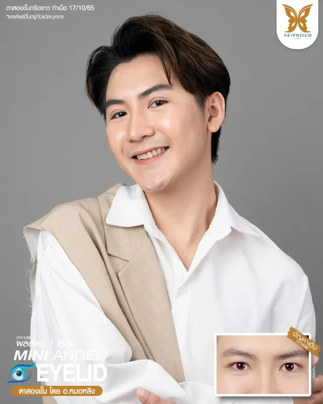 ภาพรีวิวคนสวย ตาสองชั้นผู้ชายเทคนิค กรีดตายาว โดย อ.หมอหลิง (พญ.กัญญ์ชิสา) บีพราวด์คลินิก แสดงผลลัพธ์ ชั้นตาสวยคมชัด ดวงตาดูสดใส