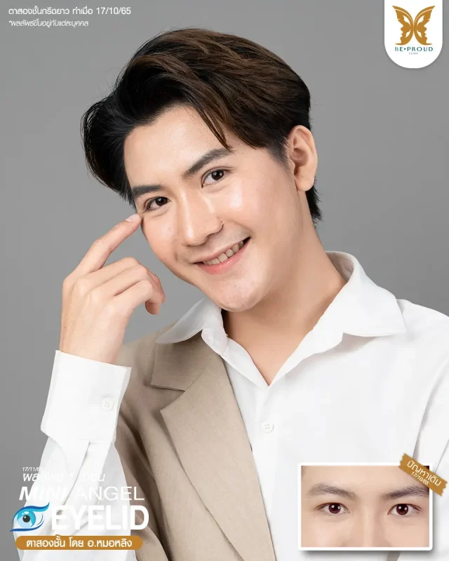 ภาพรีวิวคนสวย ตาสองชั้นผู้ชายเทคนิค กรีดตายาว โดย อ.หมอหลิง (พญ.กัญญ์ชิสา) บีพราวด์คลินิก แสดงผลลัพธ์ ชั้นตาสวยคมชัด ดวงตาดูสดใส