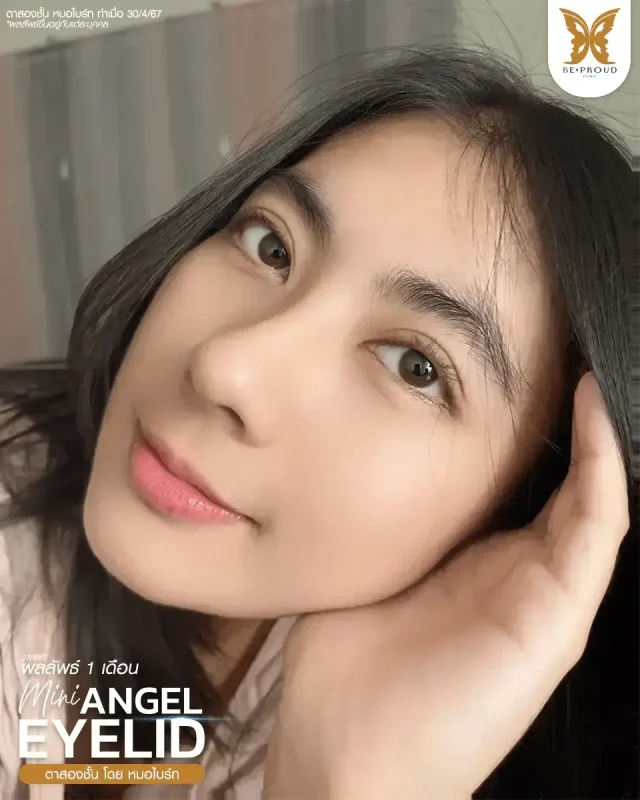 ภาพรีวิวคนสวย ตาสองชั้นกรีดตายาวแผลมินิ โดย หมอไบร์ท (นพ.ชยุตม์) บีพราวด์คลินิก แสดงผลลัพธ์ ชั้นตาสวยคมชัด ดวงตาดูสดใส