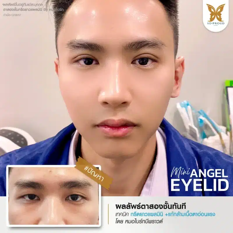 ภาพรีวิวเปรียบเทียบผลลัพธ์ ก่อนทำ-หลังทำศัลยกรรมตาสองชั้นผู้ชาย ของเคสตัวอย่าง เทคนิคกรีดตายาวแผลมินิ โดยหมอไบร์ท บีพราวด์คลินิก