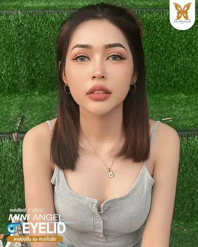 ภาพรีวิวคนสวย ตาสองชั้นกรีดตายาว โดย หมอไบร์ท (นพ.ชยุตม์) บีพราวด์คลินิก แสดงผลลัพธ์ ชั้นตาสวยคมชัด ดวงตาดูสดใส
