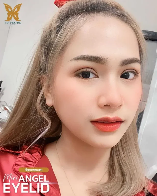 ภาพรีวิวคนสวย ตาสองชั้นกรีดตายาวแผลมินิ โดย หมอไบร์ท (นพ.ชยุตม์) บีพราวด์คลินิก แสดงผลลัพธ์ ชั้นตาสวยคมชัด ดวงตาดูสดใส