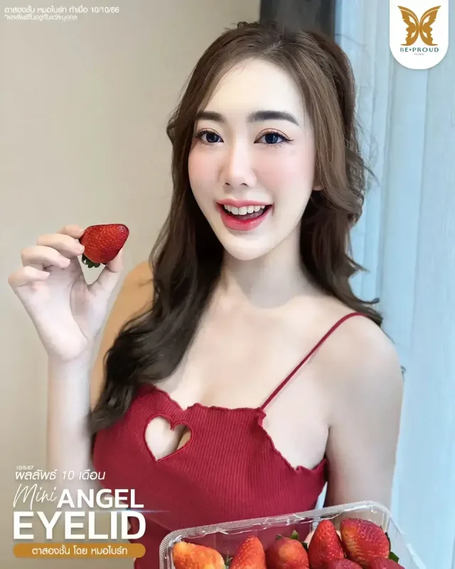 ภาพรีวิวคนสวย ตาสองชั้นกรีดตายาวแผลมินิ โดย หมอไบร์ท (นพ.ชยุตม์) บีพราวด์คลินิก แสดงผลลัพธ์ ชั้นตาสวยคมชัด ดวงตาดูสดใส