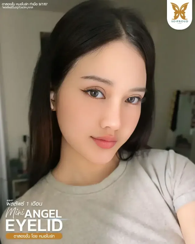 ภาพรีวิวคนสวย ตาสองชั้นกรีดตายาวแผลมินิ โดย หมอไบร์ท (นพ.ชยุตม์) บีพราวด์คลินิก แสดงผลลัพธ์ ชั้นตาสวยคมชัด ดวงตาดูสดใส