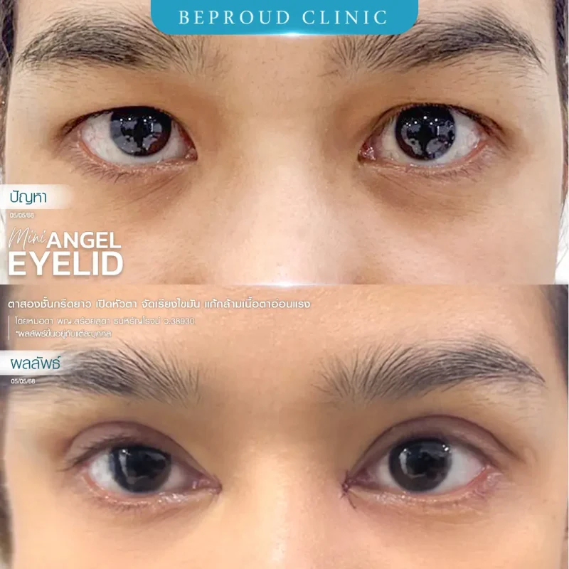 ภาพรีวิวเปรียบเทียบผลลัพธ์ ก่อนทำ-หลังทำศัลยกรรมตาสองชั้น ของเคสตัวอย่าง เทคนิคกรีดตายาว เปิดหัวตา จัดเรียงไขมัน แก้กล้ามเนื้อตาอ่อนแรง โดยหมอดา บีพราวด์คลินิก
