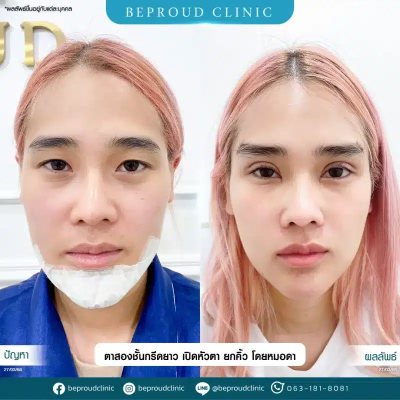 ภาพรีวิวเปรียบเทียบผลลัพธ์ ก่อนทำ-หลังทำศัลยกรรมตาสองชั้น ของเคสตัวอย่าง เทคนิคกรีดตายาว เปิดหัวตา ยกคิ้ว โดยหมอดา บีพราวด์คลินิก