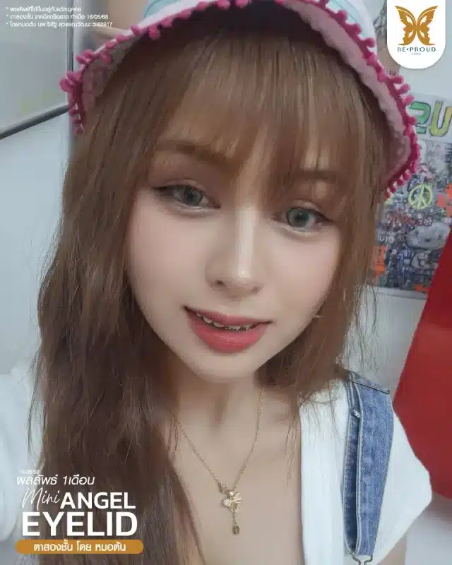 ภาพรีวิวคนสวย ตาสองชั้นกรีดตายาว โดยหมอต้น (นพ.จิรัฐ) บีพราวด์คลินิก แสดงผลลัพธ์ ชั้นตาสวยคมชัด ดวงตาดูสดใส