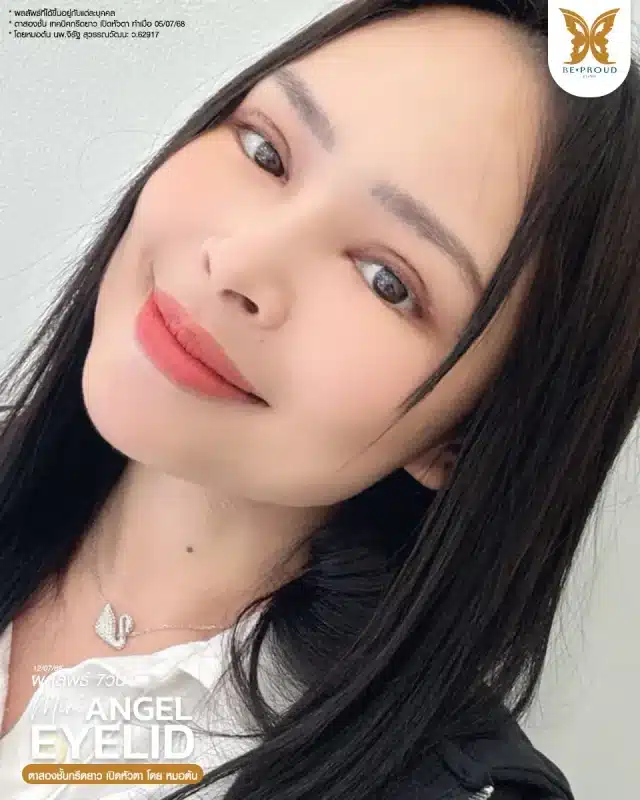 ภาพรีวิวคนสวย ตาสองชั้นกรีดตายาว เปิดหัวตา โดยหมอต้น (นพ.จิรัฐ) บีพราวด์คลินิก แสดงผลลัพธ์ ชั้นตาสวยคมชัด ดวงตาดูสดใส