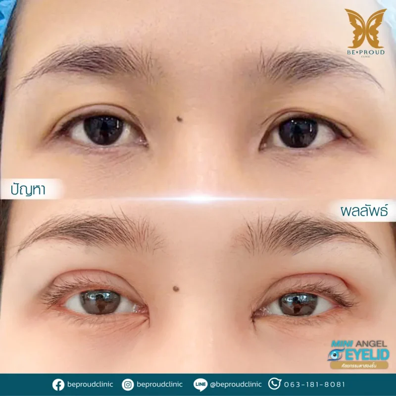 ภาพรีวิวเปรียบเทียบผลลัพธ์ ก่อนทำ-หลังทำศัลยกรรมตาสองชั้น ของเคสตัวอย่าง เทคนิคกรีดตายาว เปิดหัวตา แก้กล้ามเนื้อตาอ่อนแรง โดยหมอดา บีพราวด์คลินิก