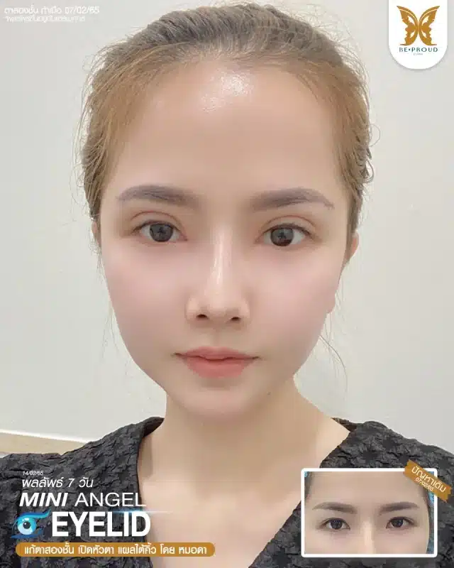ภาพรีวิวคนสวย แก้ตาสองชั้นกรีดตายาว เปิดหัวตา แผลใต้คิ้ว โดยหมอดา (พญ.สร้อยสุดา) บีพราวด์คลินิก แสดงผลลัพธ์ ชั้นตาสวยคมชัด ดวงตาดูสดใส