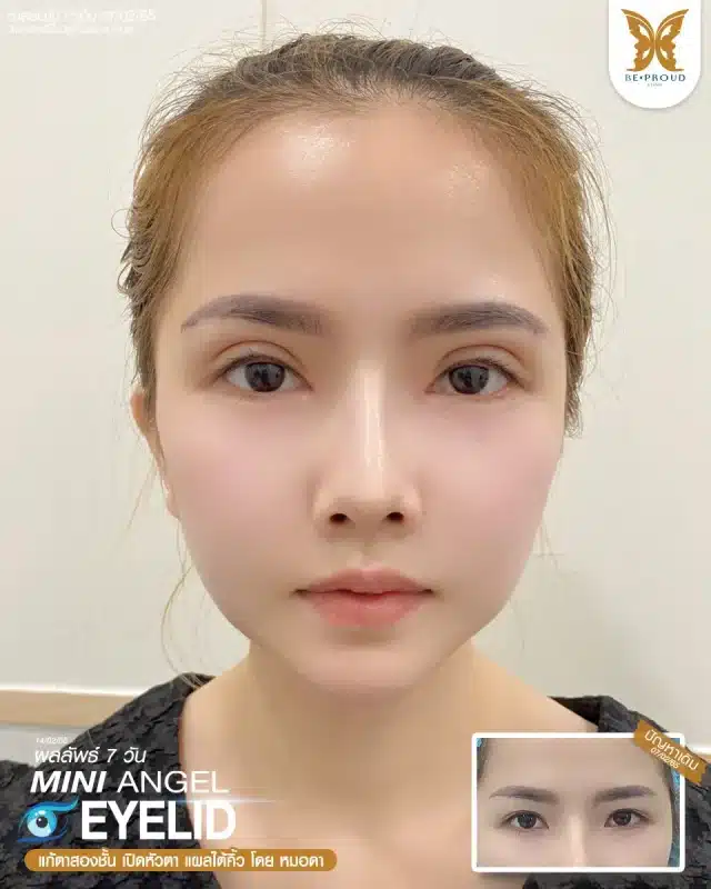 ภาพรีวิวคนสวย แก้ตาสองชั้นกรีดตายาว เปิดหัวตา แผลใต้คิ้ว โดยหมอดา (พญ.สร้อยสุดา) บีพราวด์คลินิก แสดงผลลัพธ์ ชั้นตาสวยคมชัด ดวงตาดูสดใส