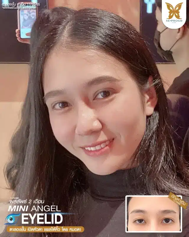 ภาพรีวิวคนสวย ตาสองชั้นกรีดตายาว เปิดหัวตา แผลใต้คิ้ว โดยหมอดา (พญ.สร้อยสุดา) บีพราวด์คลินิก แสดงผลลัพธ์ ชั้นตาสวยคมชัด ดวงตาดูสดใส