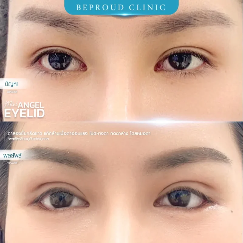 ภาพรีวิวเปรียบเทียบผลลัพธ์ ก่อนทำ-หลังทำศัลยกรรมตาสองชั้น ของเคสตัวอย่าง เทคนิคกรีดตายาว แก้กล้ามเนื้อตาอ่อนแรง เปิดหางตา กดตาล่าง โดยหมอดา บีพราวด์คลินิก