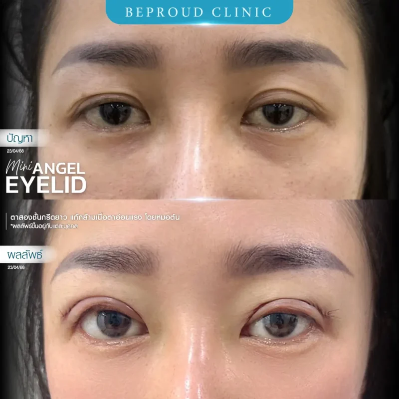 ภาพรีวิวเปรียบเทียบผลลัพธ์ ก่อนทำ-หลังทำศัลยกรรมตาสองชั้น ของเคสตัวอย่าง เทคนิคกรีดตายาว แก้กล้ามเนื้อตาอ่อนแรง โดยหมอต้น บีพราวด์คลินิก