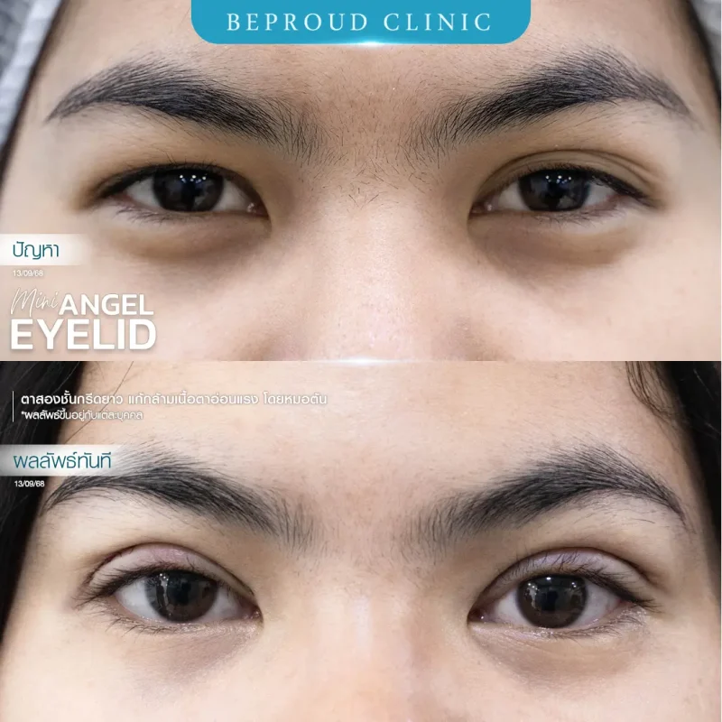 ภาพรีวิวเปรียบเทียบผลลัพธ์ ก่อนทำ-หลังทำศัลยกรรมตาสองชั้น ของเคสตัวอย่าง เทคนิคกรีดตายาว แก้กล้ามเนื้อตาอ่อนแรง โดยหมอต้น บีพราวด์คลินิก