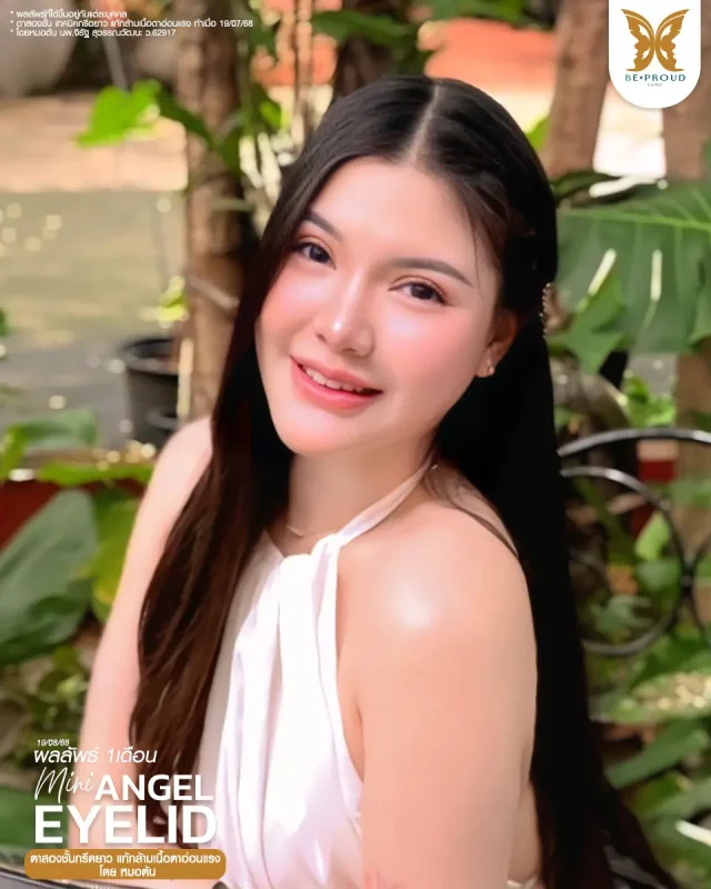 ภาพรีวิวคนสวย ตาสองชั้นกรีดตายาว แก้กล้ามเนื้อตาอ่อนแรง โดยหมอต้น (นพ.จิรัฐ) บีพราวด์คลินิก แสดงผลลัพธ์ ชั้นตาสวยคมชัด ดวงตาดูสดใส