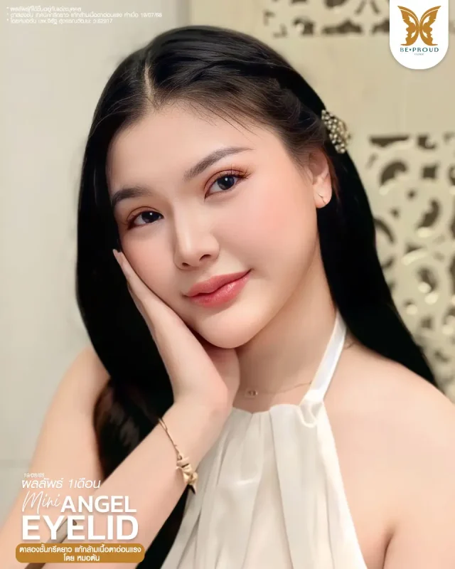 ภาพรีวิวคนสวย ตาสองชั้นกรีดตายาว แก้กล้ามเนื้อตาอ่อนแรง โดยหมอต้น (นพ.จิรัฐ) บีพราวด์คลินิก แสดงผลลัพธ์ ชั้นตาสวยคมชัด ดวงตาดูสดใส