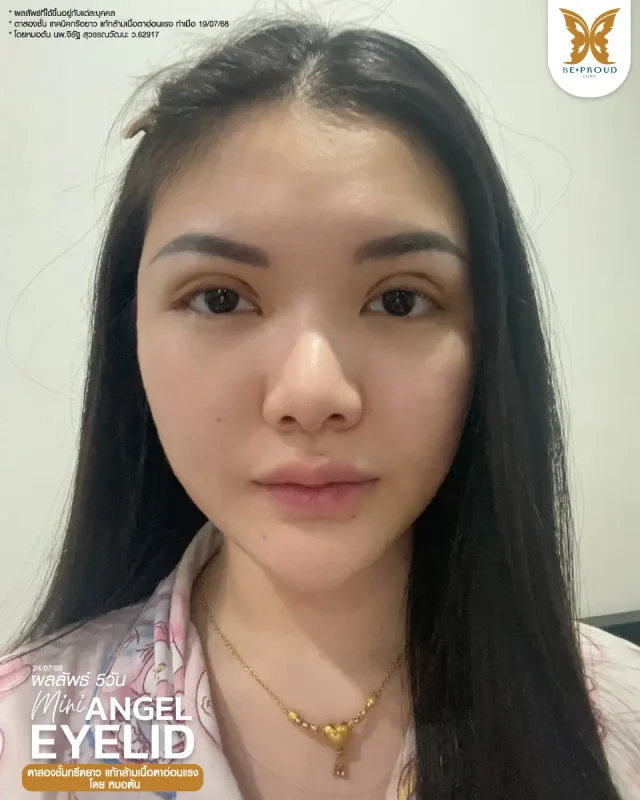 ภาพรีวิวคนสวย ตาสองชั้นกรีดตายาว แก้กล้ามเนื้อตาอ่อนแรง โดยหมอต้น (นพ.จิรัฐ) บีพราวด์คลินิก แสดงผลลัพธ์ ชั้นตาสวยคมชัด ดวงตาดูสดใส