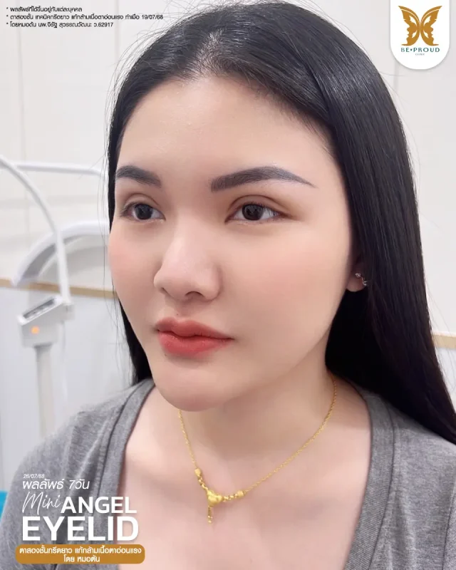 ภาพรีวิวคนสวย ตาสองชั้นกรีดตายาว แก้กล้ามเนื้อตาอ่อนแรง โดยหมอต้น (นพ.จิรัฐ) บีพราวด์คลินิก แสดงผลลัพธ์ ชั้นตาสวยคมชัด ดวงตาดูสดใส