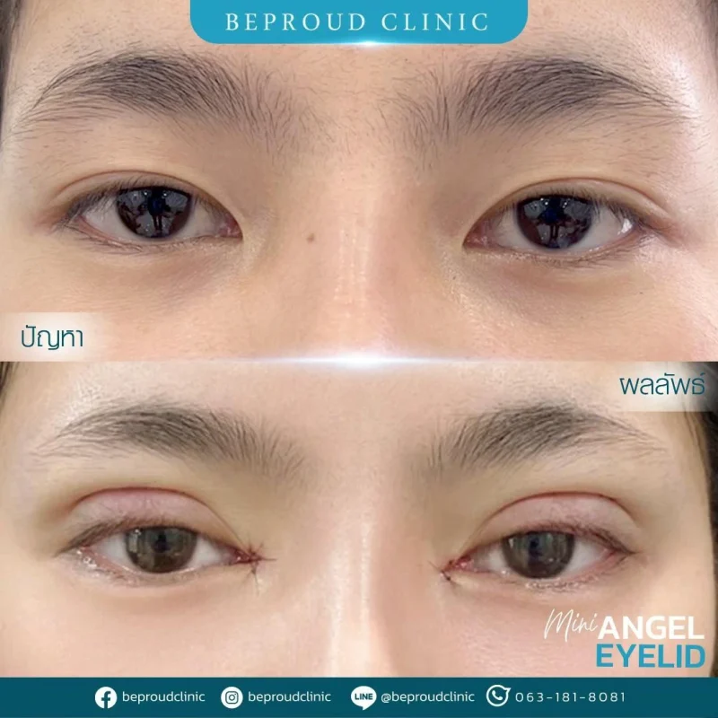 ภาพรีวิวเปรียบเทียบผลลัพธ์ ก่อนทำ-หลังทำศัลยกรรมตาสองชั้น ของเคสตัวอย่าง เทคนิคกรีดตายาว เปิดหัวตา แก้กล้ามเนื้อตาอ่อนแรง โดยหมอดา บีพราวด์คลินิก