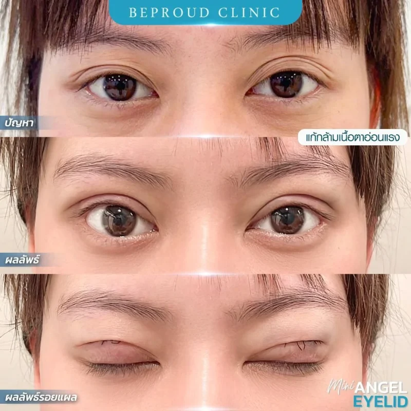 ภาพรีวิวเปรียบเทียบผลลัพธ์ ก่อนทำ-หลังทำศัลยกรรมตาสองชั้น ของเคสตัวอย่าง เทคนิคกรีดตายาว แก้กล้ามเนื้อตาอ่อนแรง โดยหมอดา บีพราวด์คลินิก