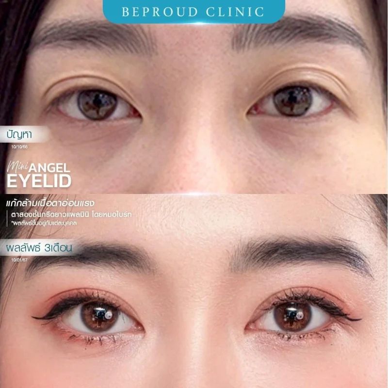 ภาพรีวิวเปรียบเทียบผลลัพธ์ ก่อนทำ-หลังทำศัลยกรรมตาสองชั้น ของเคสตัวอย่าง เทคนิคกรีดตายาวแผลมินิ แก้กล้ามเนื้อตาอ่อนแรง โดยหมอไบร์ท บีพราวด์คลินิก