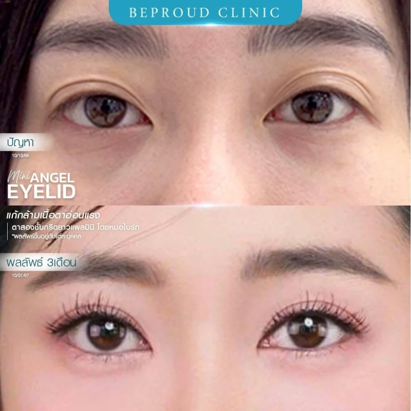 ภาพรีวิวเปรียบเทียบผลลัพธ์ ก่อนทำ-หลังทำศัลยกรรมตาสองชั้น ของเคสตัวอย่าง เทคนิคกรีดตายาวแผลมินิ แก้กล้ามเนื้อตาอ่อนแรง โดยหมอไบร์ท บีพราวด์คลินิก