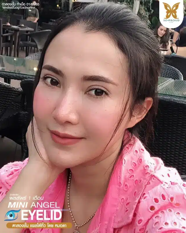 ภาพรีวิวคนสวย ตาสองชั้นกรีดตายาว แผลใต้คิ้ว โดยหมอดา (พญ.สร้อยสุดา) บีพราวด์คลินิก แสดงผลลัพธ์ ชั้นตาสวยคมชัด ดวงตาดูสดใส