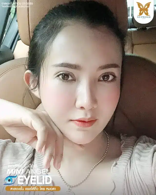 ภาพรีวิวคนสวย ตาสองชั้นกรีดตายาว แผลใต้คิ้ว โดยหมอดา (พญ.สร้อยสุดา) บีพราวด์คลินิก แสดงผลลัพธ์ ชั้นตาสวยคมชัด ดวงตาดูสดใส
