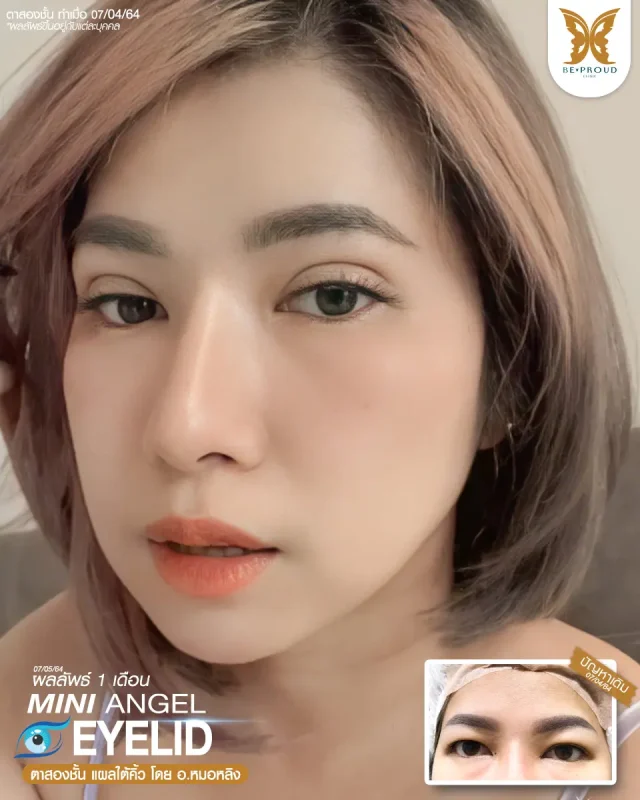 ภาพรีวิวคนสวย ตาสองชั้น เทคนิคกรีดตายาว แผลใต้คิ้ว โดย อ.หมอหลิง (พญ.กัญญ์ชิสา) บีพราวด์คลินิก แสดงผลลัพธ์ ชั้นตาสวยคมชัด ดวงตาดูสดใส