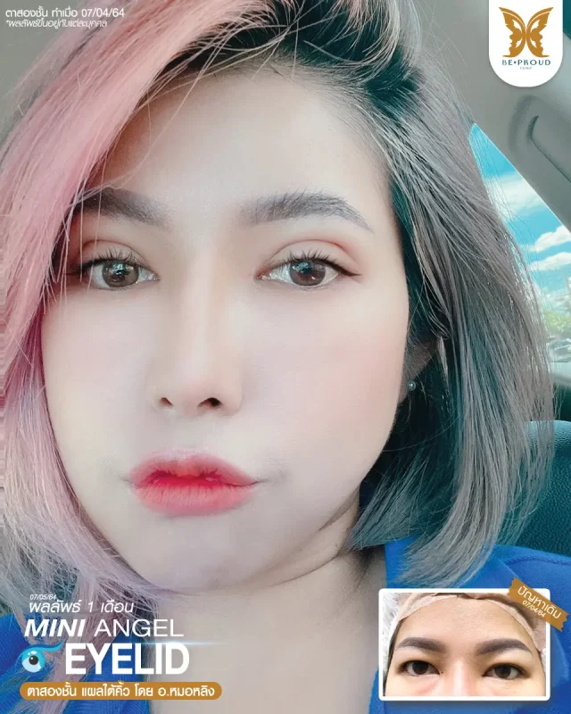 ภาพรีวิวคนสวย ตาสองชั้น เทคนิคกรีดตายาว แผลใต้คิ้ว โดย อ.หมอหลิง (พญ.กัญญ์ชิสา) บีพราวด์คลินิก แสดงผลลัพธ์ ชั้นตาสวยคมชัด ดวงตาดูสดใส