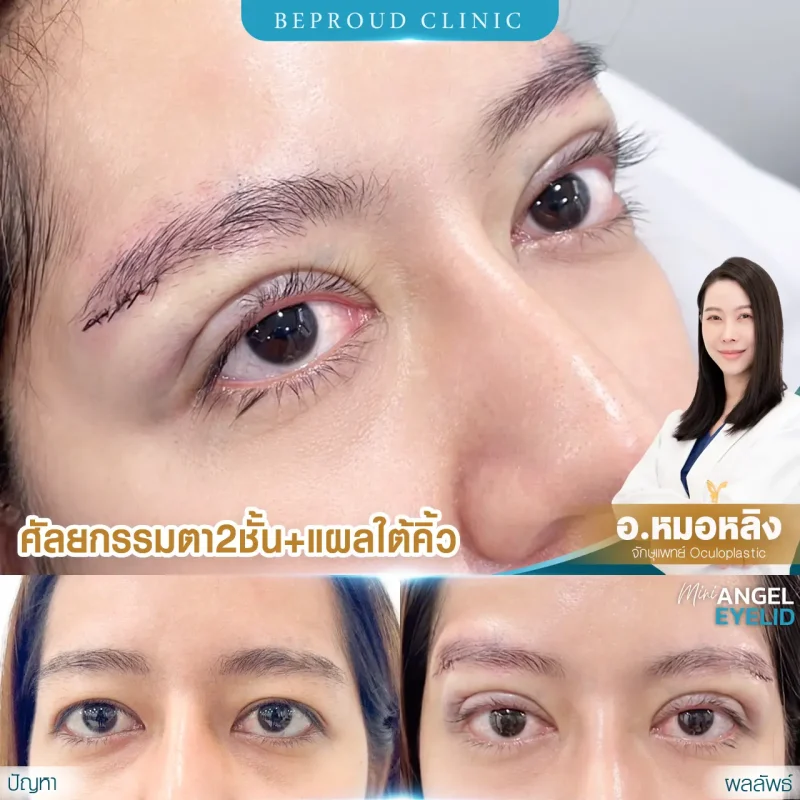 ภาพรีวิวเปรียบเทียบผลลัพธ์ ก่อนทำ-หลังทำศัลยกรรมตาสองชั้น ของเคสตัวอย่าง เทคนิคกรีดตายาว แผลใต้คิ้ว โดยอ.หมอหลิง บีพราวด์คลินิก