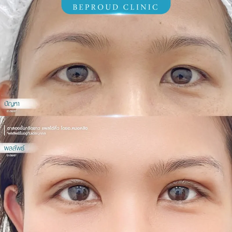 ภาพรีวิวเปรียบเทียบผลลัพธ์ ก่อนทำ-หลังทำศัลยกรรมตาสองชั้น ของเคสตัวอย่าง เทคนิคกรีดตายาว แผลใต้คิ้วโดยอ.หมอหลิง บีพราวด์คลินิก