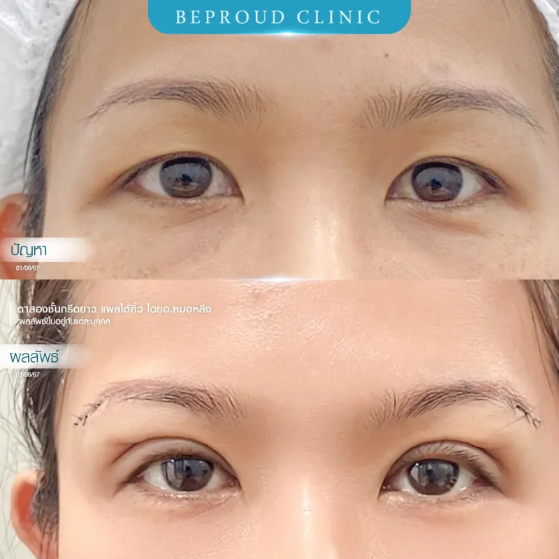 ภาพรีวิวเปรียบเทียบผลลัพธ์ ก่อนทำ-หลังทำศัลยกรรมตาสองชั้น ของเคสตัวอย่าง เทคนิคกรีดตายาว แผลใต้คิ้วโดยอ.หมอหลิง บีพราวด์คลินิก