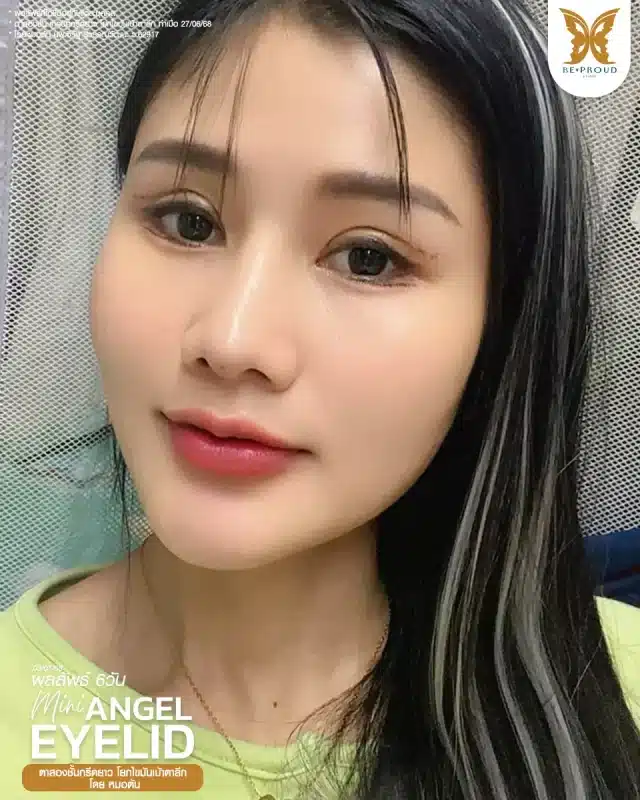 ภาพรีวิวคนสวย ตาสองชั้นกรีดตายาว โดยหมอต้น (นพ.จิรัฐ) บีพราวด์คลินิก แสดงผลลัพธ์ ชั้นตาสวยคมชัด ดวงตาดูสดใส