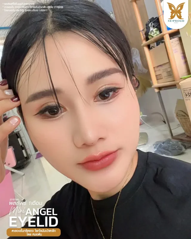 ภาพรีวิวคนสวย ตาสองชั้นกรีดตายาว โดยหมอต้น (นพ.จิรัฐ) บีพราวด์คลินิก แสดงผลลัพธ์ ชั้นตาสวยคมชัด ดวงตาดูสดใส