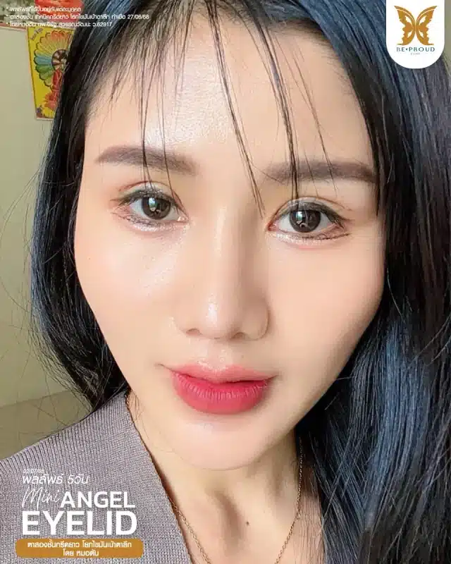 ภาพรีวิวคนสวย ตาสองชั้นกรีดตายาว โดยหมอต้น (นพ.จิรัฐ) บีพราวด์คลินิก แสดงผลลัพธ์ ชั้นตาสวยคมชัด ดวงตาดูสดใส