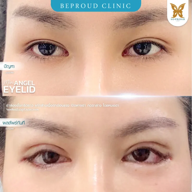 ภาพรีวิวเปรียบเทียบผลลัพธ์ ก่อนทำ-หลังทำศัลยกรรมตาสองชั้น ของเคสตัวอย่าง เทคนิคกรีดตายาว แก้กล้ามเนื้อตาอ่อนแรง เปิดหางตา กดตาล่าง โดยหมอดา บีพราวด์คลินิก