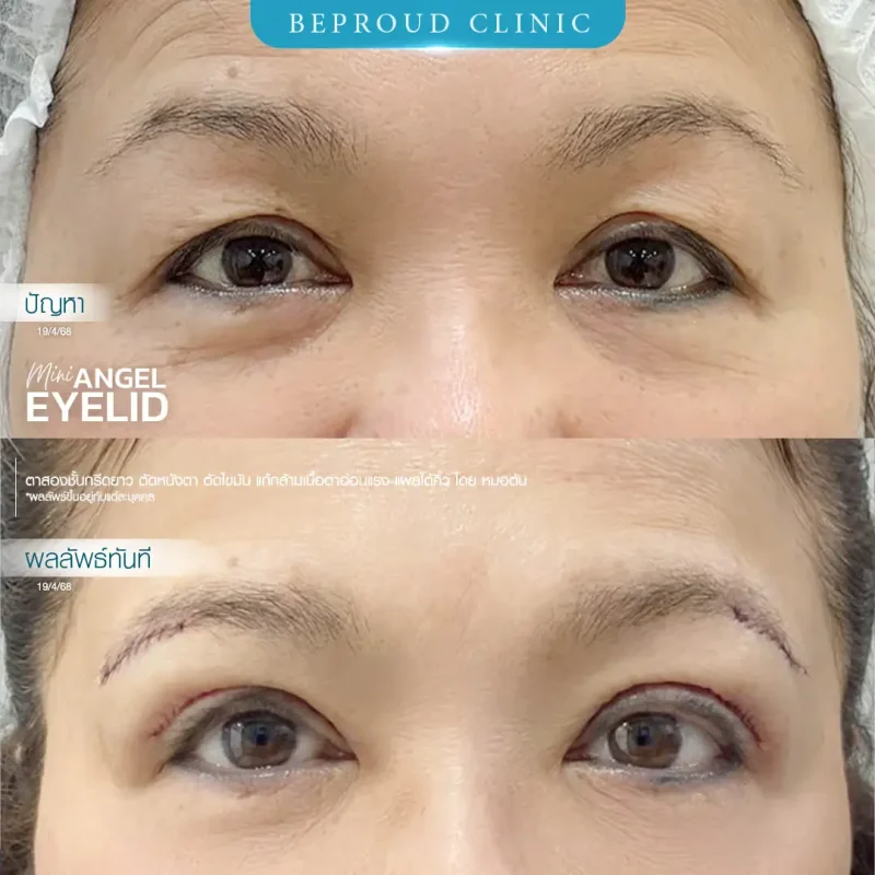 ภาพรีวิวเปรียบเทียบผลลัพธ์ ก่อนทำ-หลังทำศัลยกรรมตาสองชั้น ของเคสตัวอย่าง เทคนิคกรีดตายาว ตัดหนังตา ตัดไขมัน แก้กล้ามเนื้อตาอ่อนแรง แผลใต้คิ้ว โดยหมอต้น บีพราวด์คลินิก