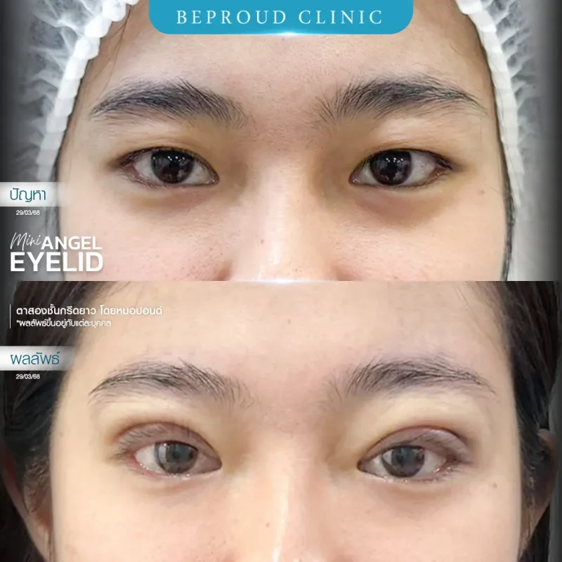 ภาพรีวิวเปรียบเทียบผลลัพธ์ ก่อนทำ-หลังทำศัลยกรรมตาสองชั้น ของเคสตัวอย่าง เทคนิคกรีดตายาว โดยหมอปอนด์ บีพราวด์คลินิก